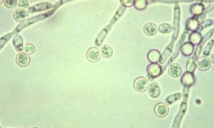 Candida: Causes, Symptoms, Diagnosis & Treatments