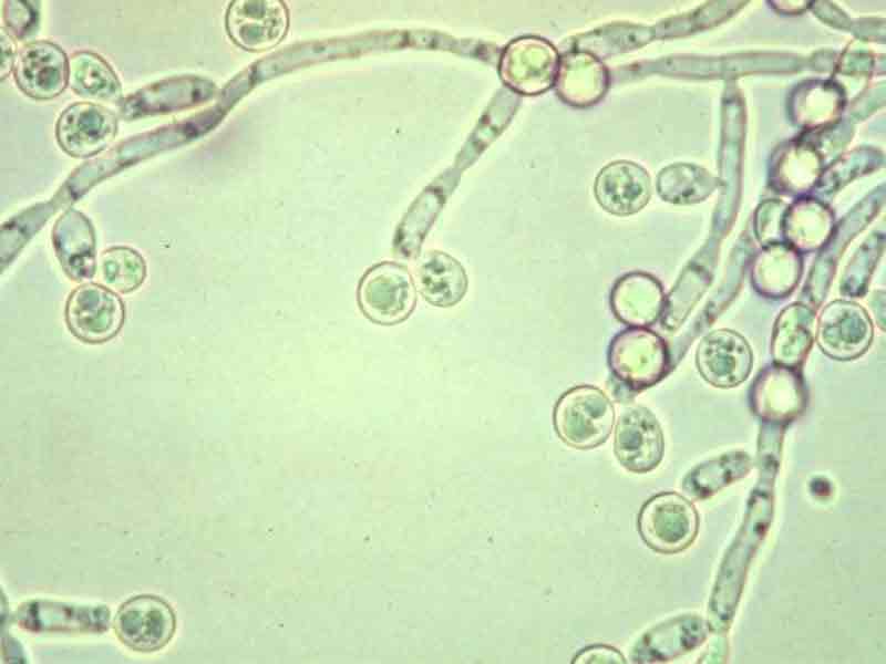 Candida: Causes, Symptoms, Diagnosis & Treatments