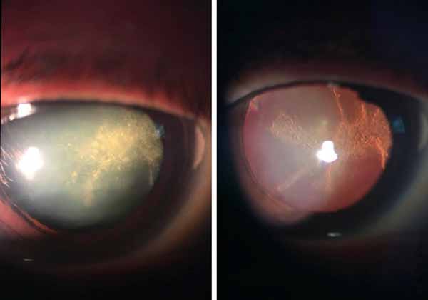 cataract before and after