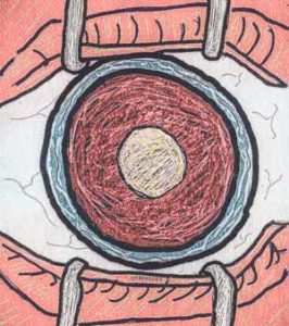 cataract_drawing_300x338