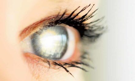 Cataract: Symptoms & Natural Treatments