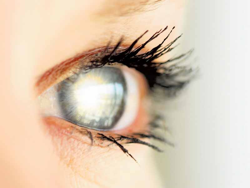 Cataract: Symptoms & Natural Treatments